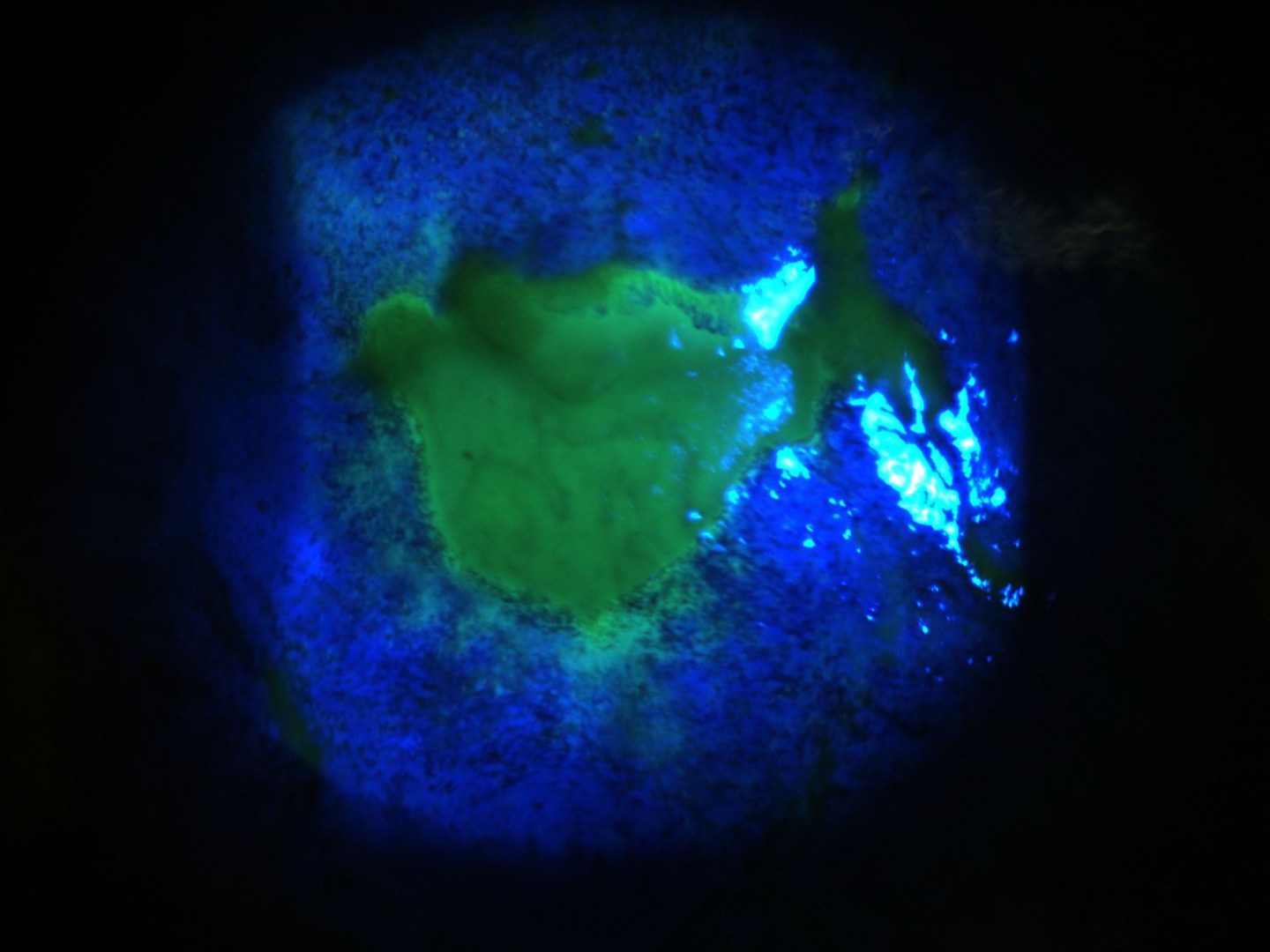 Central persitant corneal epi defect due to 360 degree limbal stem cell failure