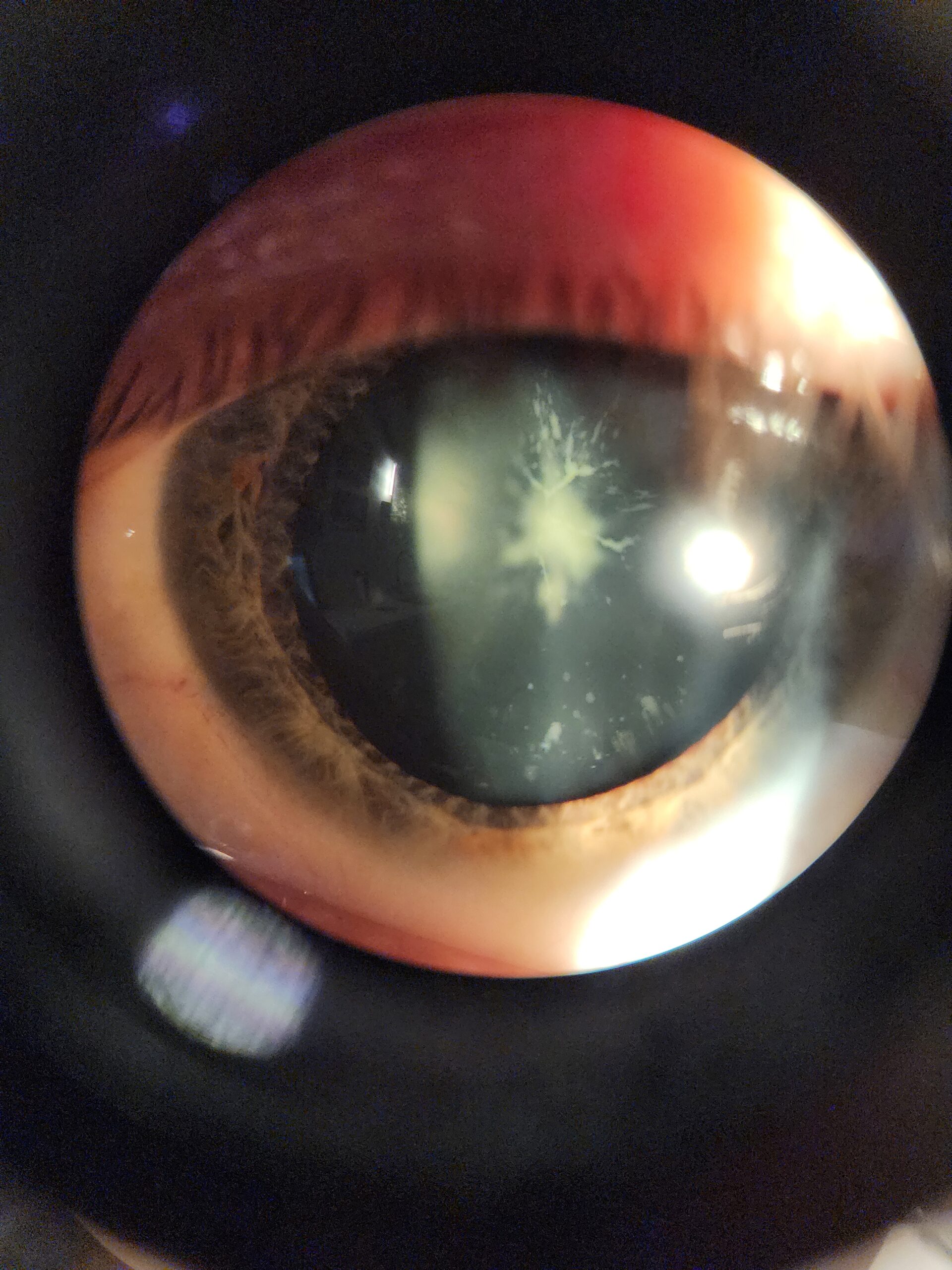 Congenital lamellar Cataract
