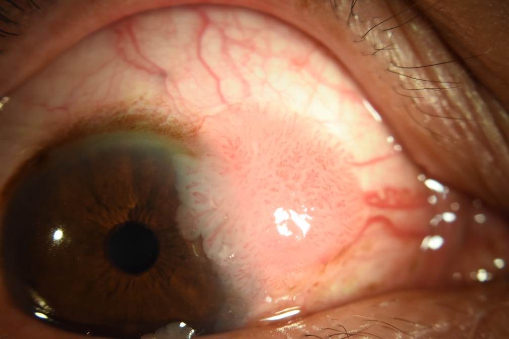 Conjunctival papilloma