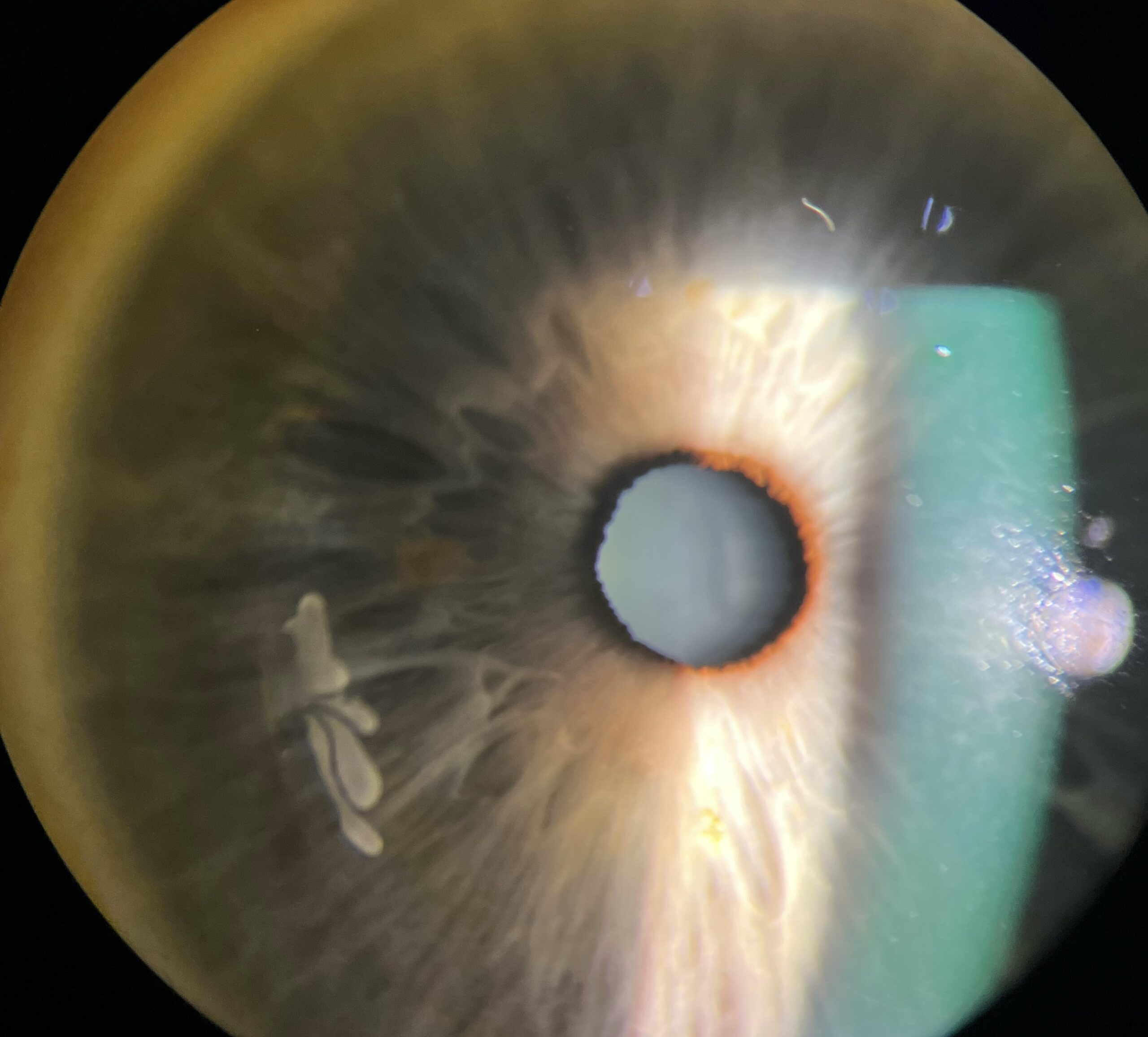 Epithelial ingrowth 2