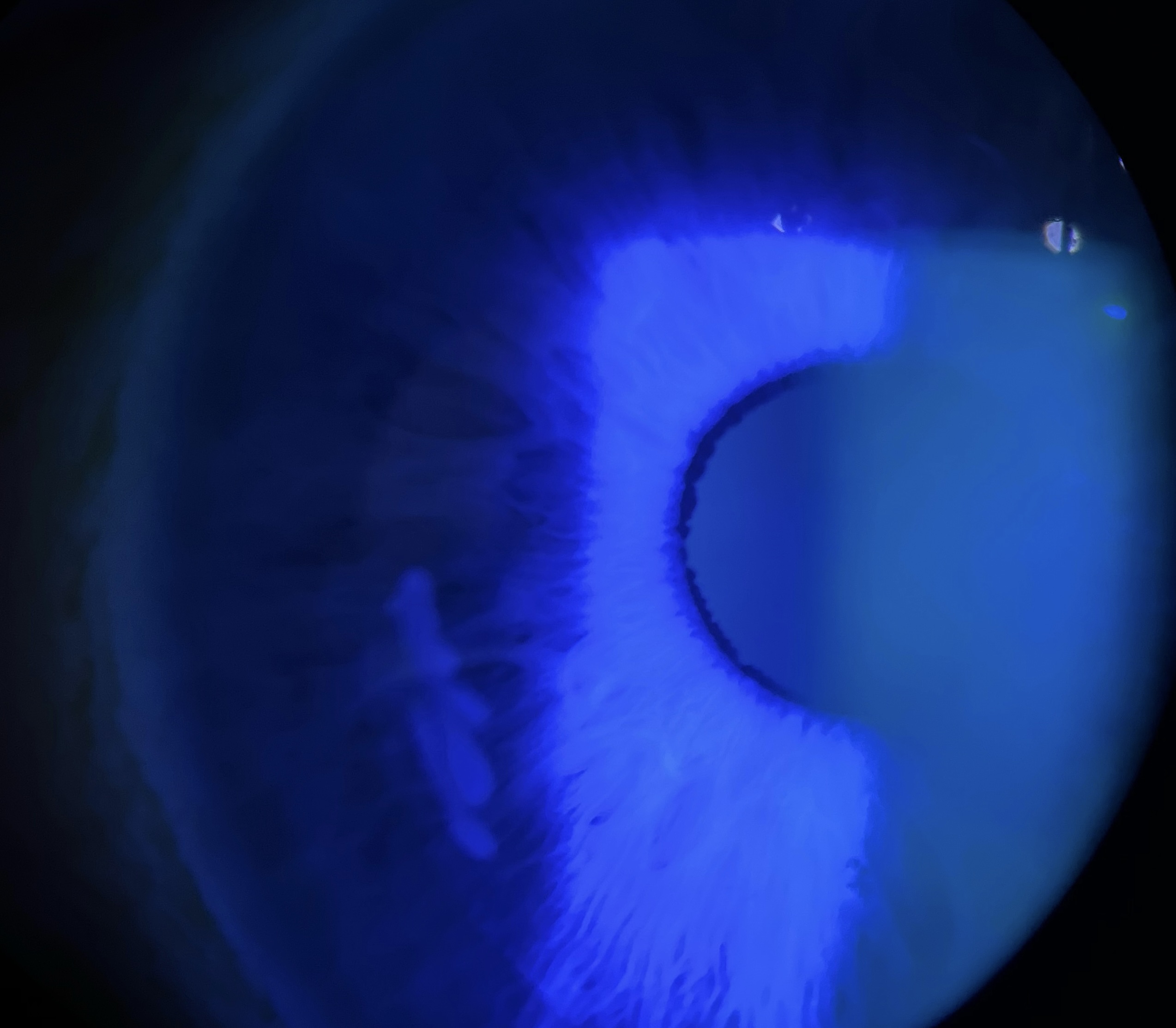 Epithelial ingrowth fluorescein