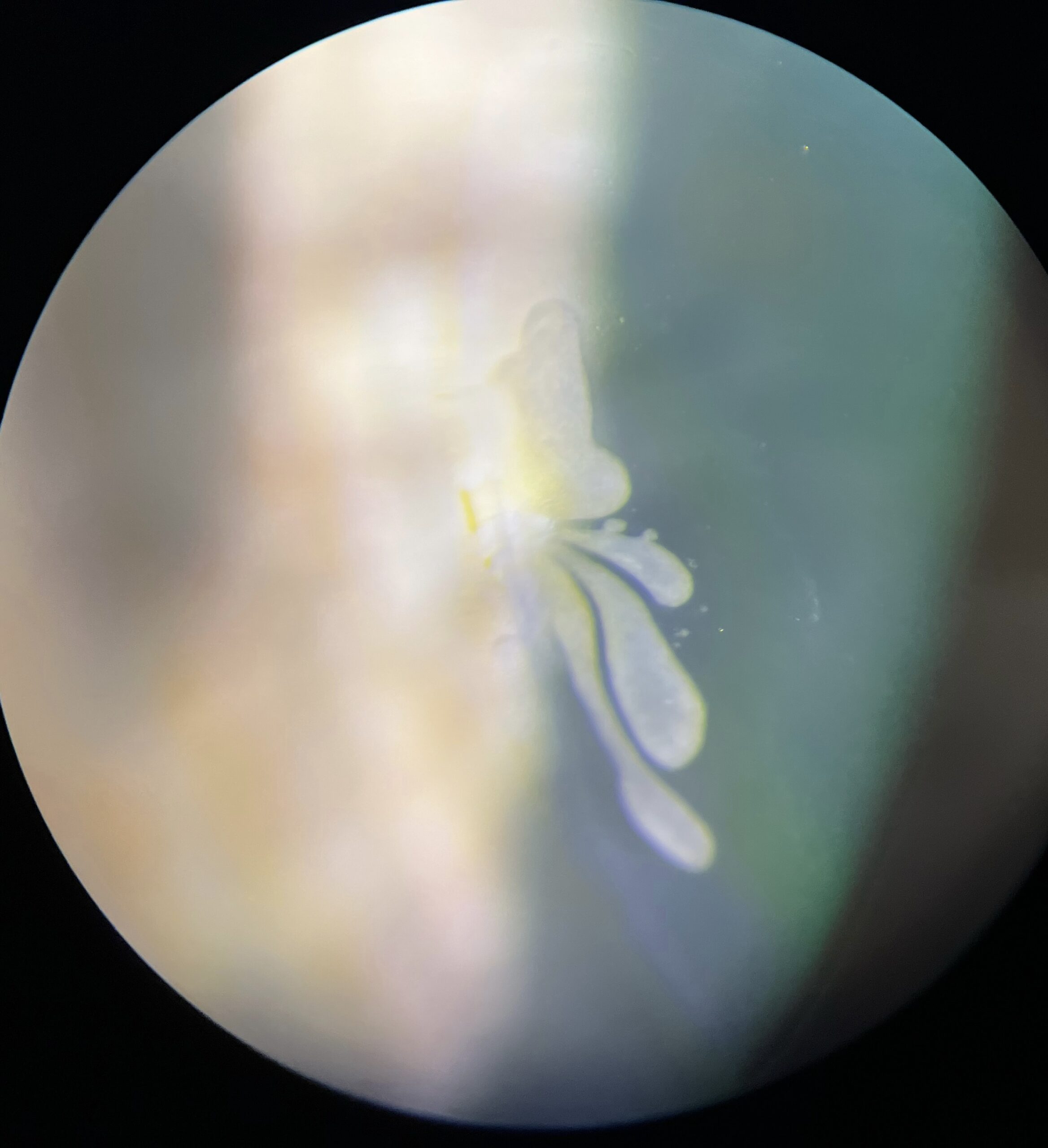 Epithelial ingrowth higher mag 1