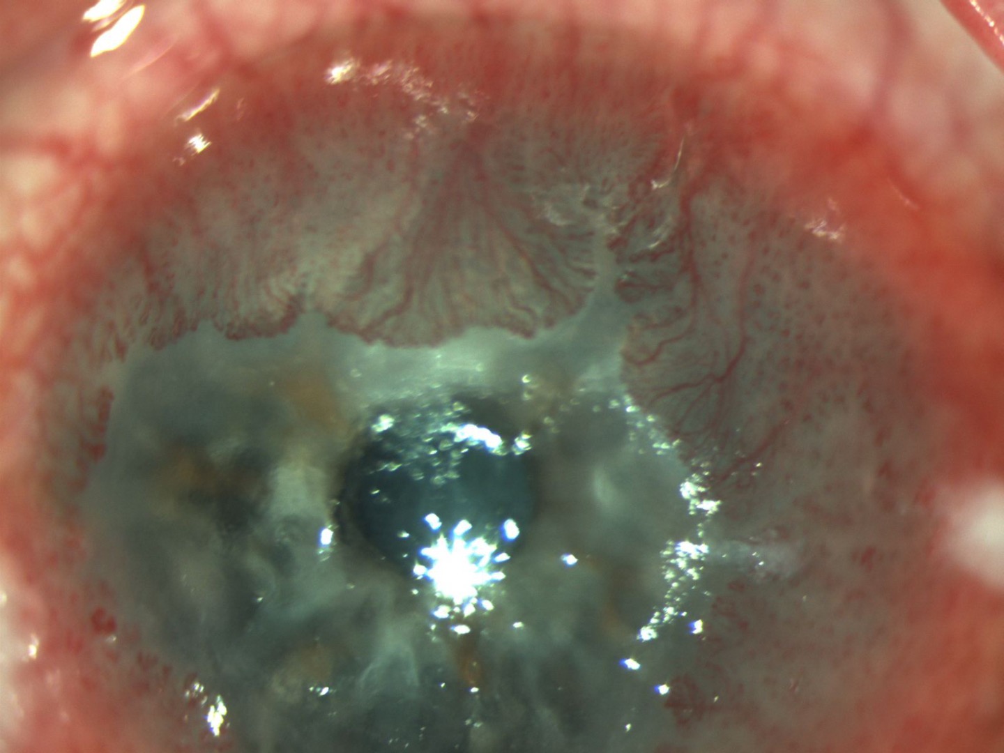 Extensive OSSN involving the limbus