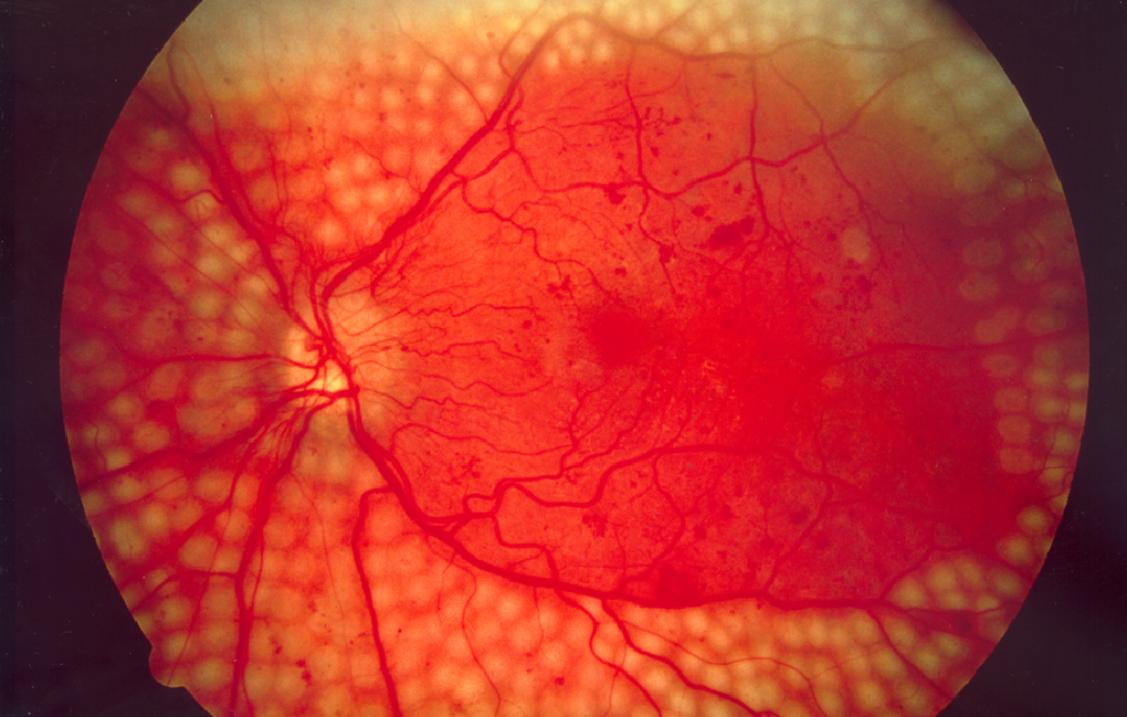 Fundus photo showing scatter laser surgery for diabetic retinopathy.