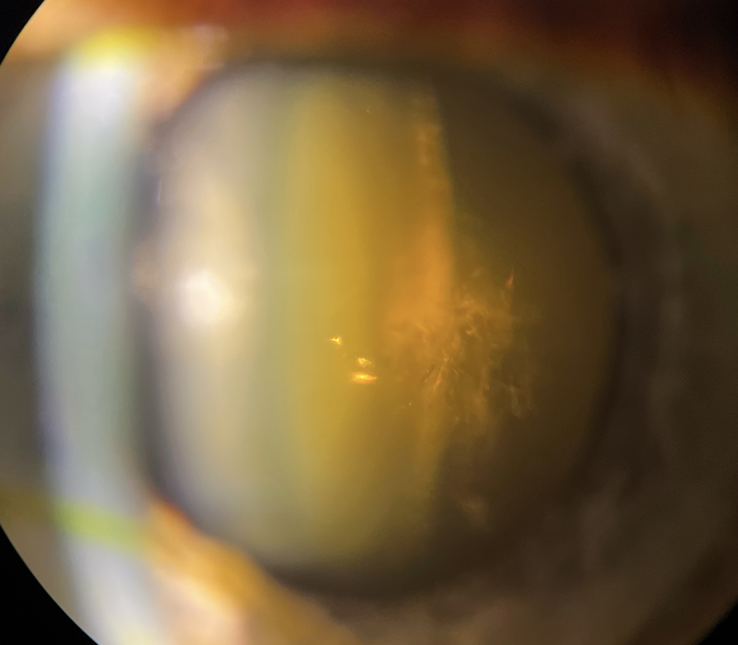 Nuclear sclerotic cataract and Posterior Subcapsular cataract