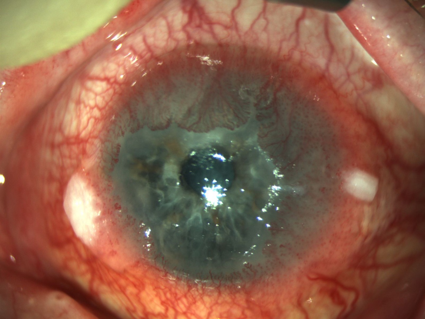 Ocular surface squamous neoplasia