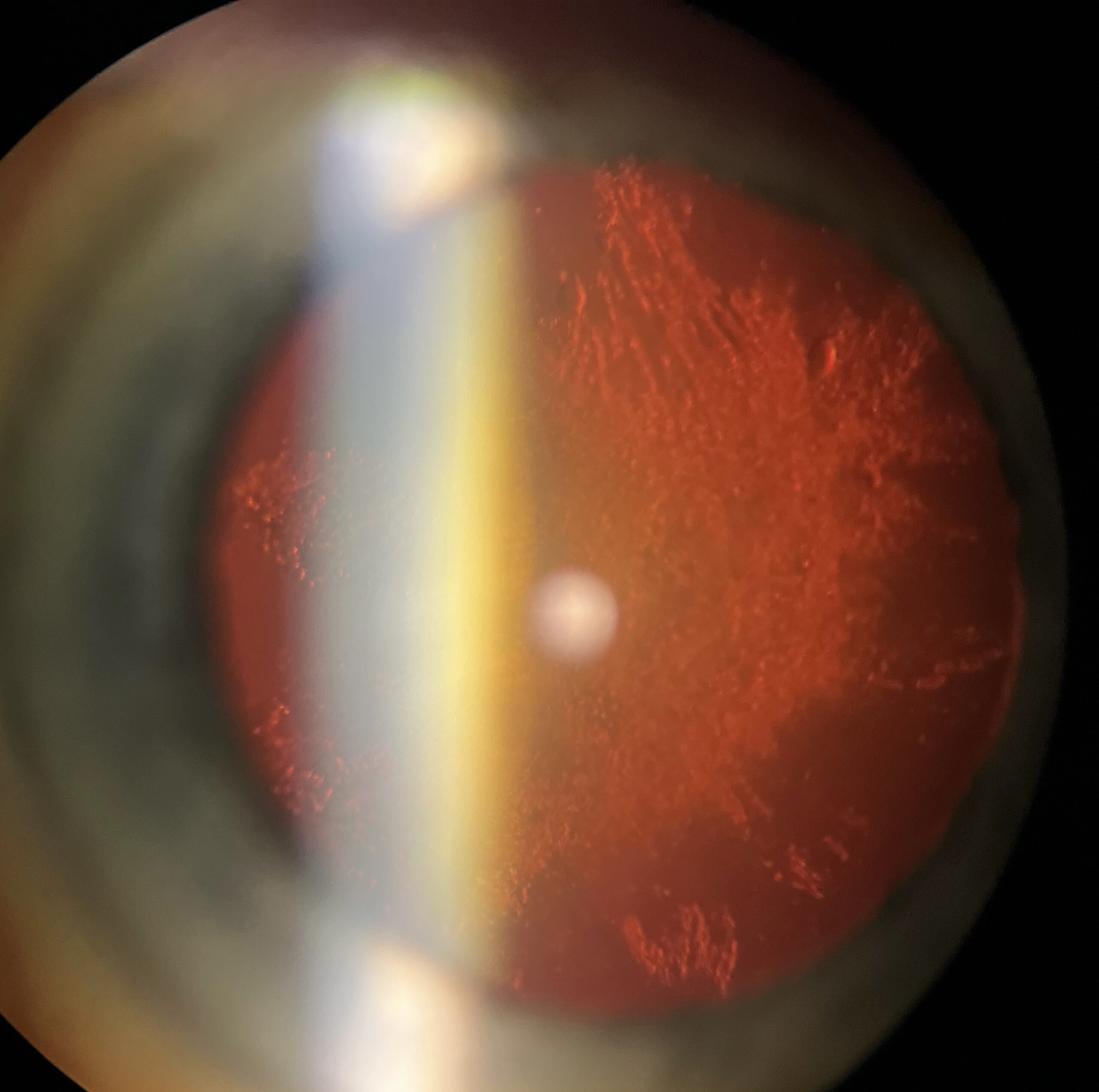 Post Subcapsular cataract