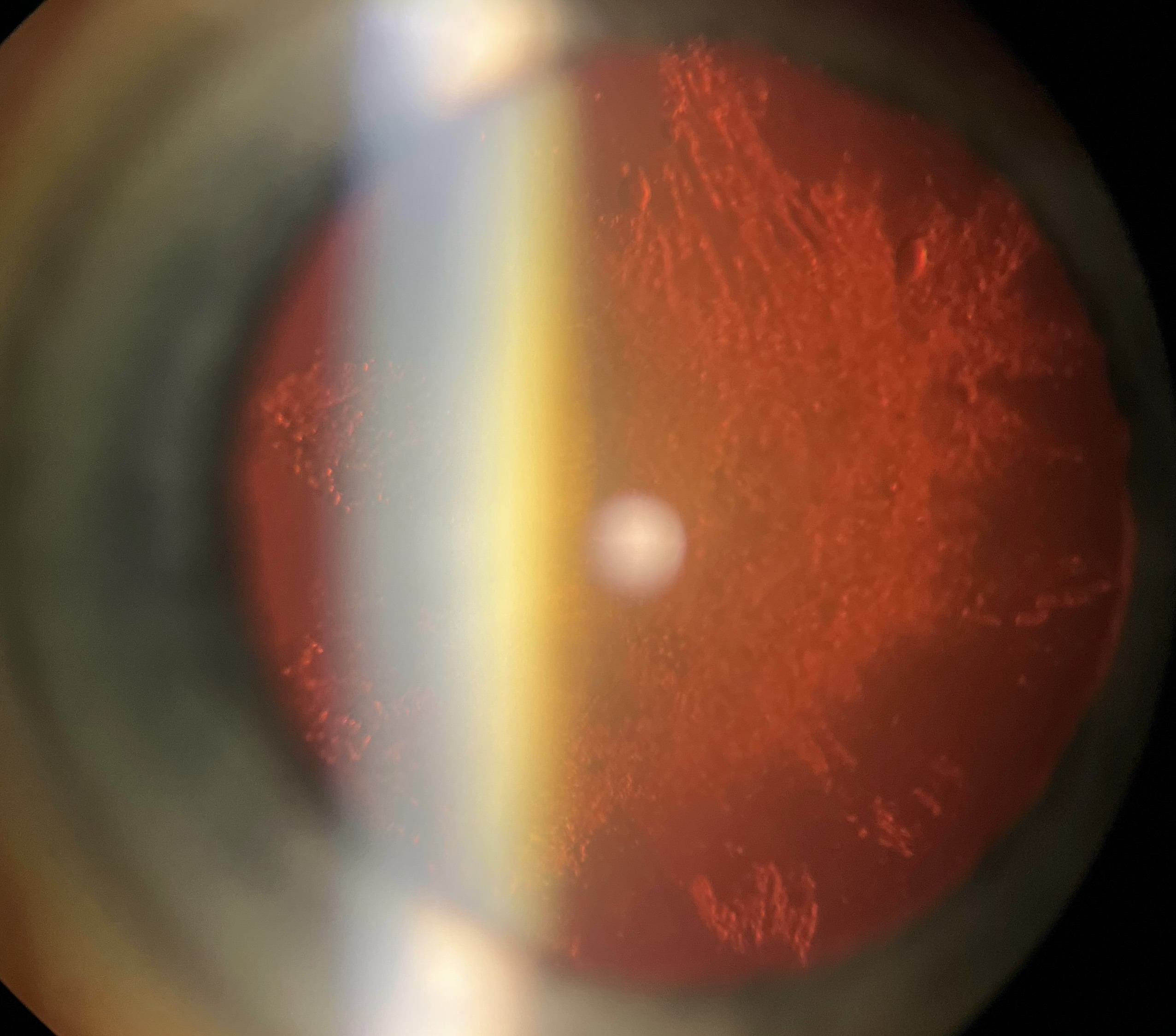 Post sub capsular cataract