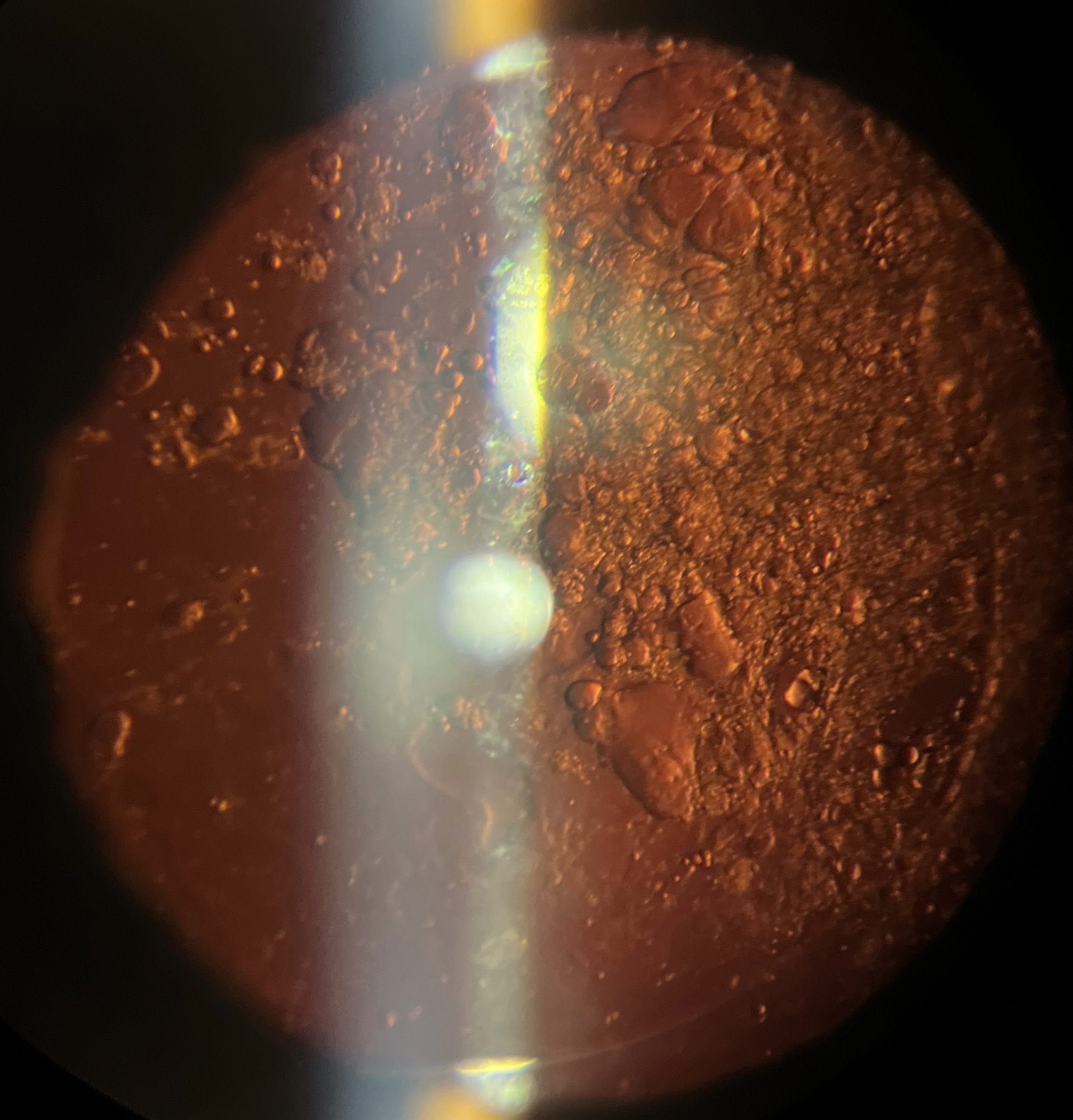 Posterior Capsule opacification