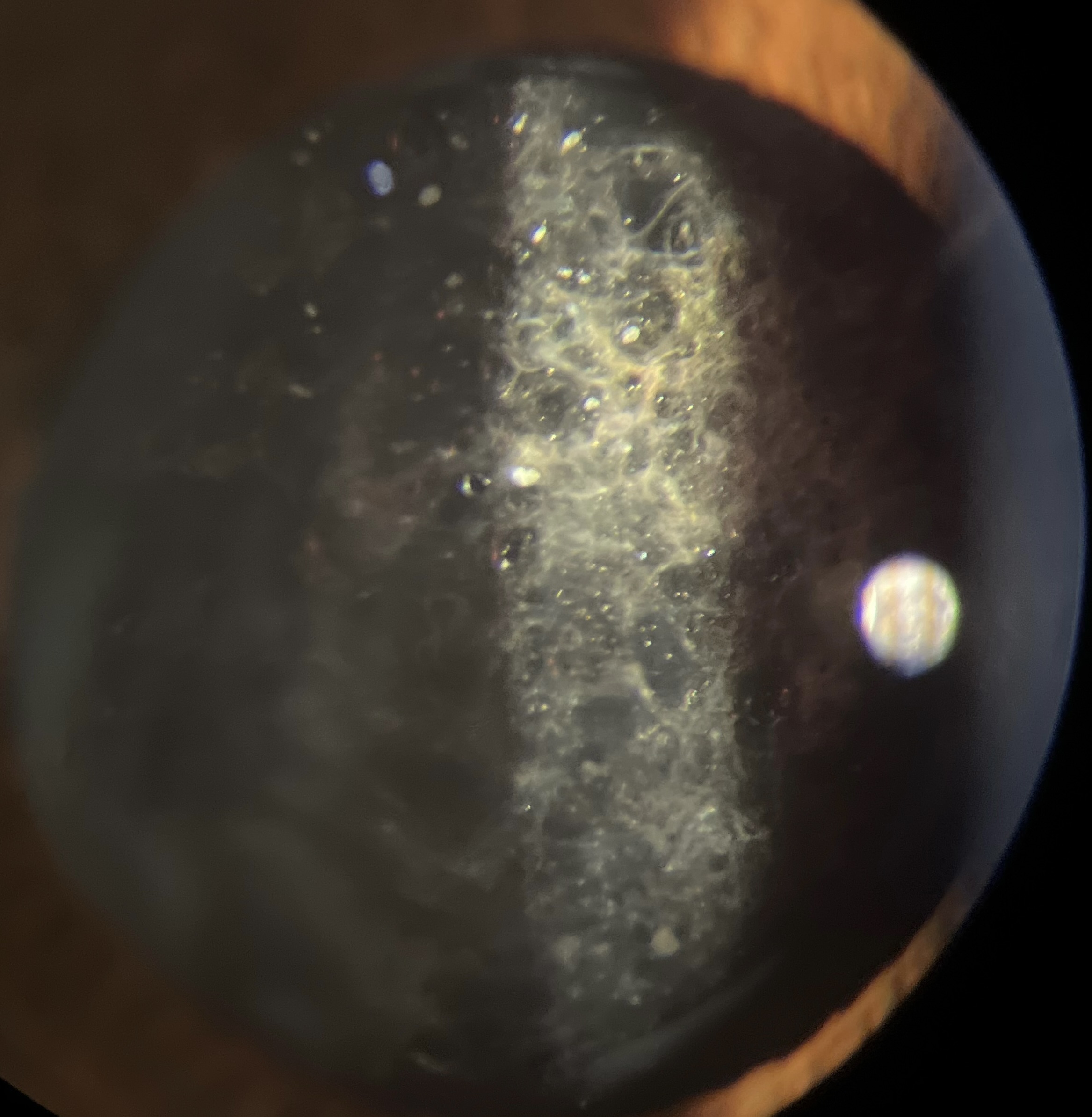 Posterior Capsule opacification