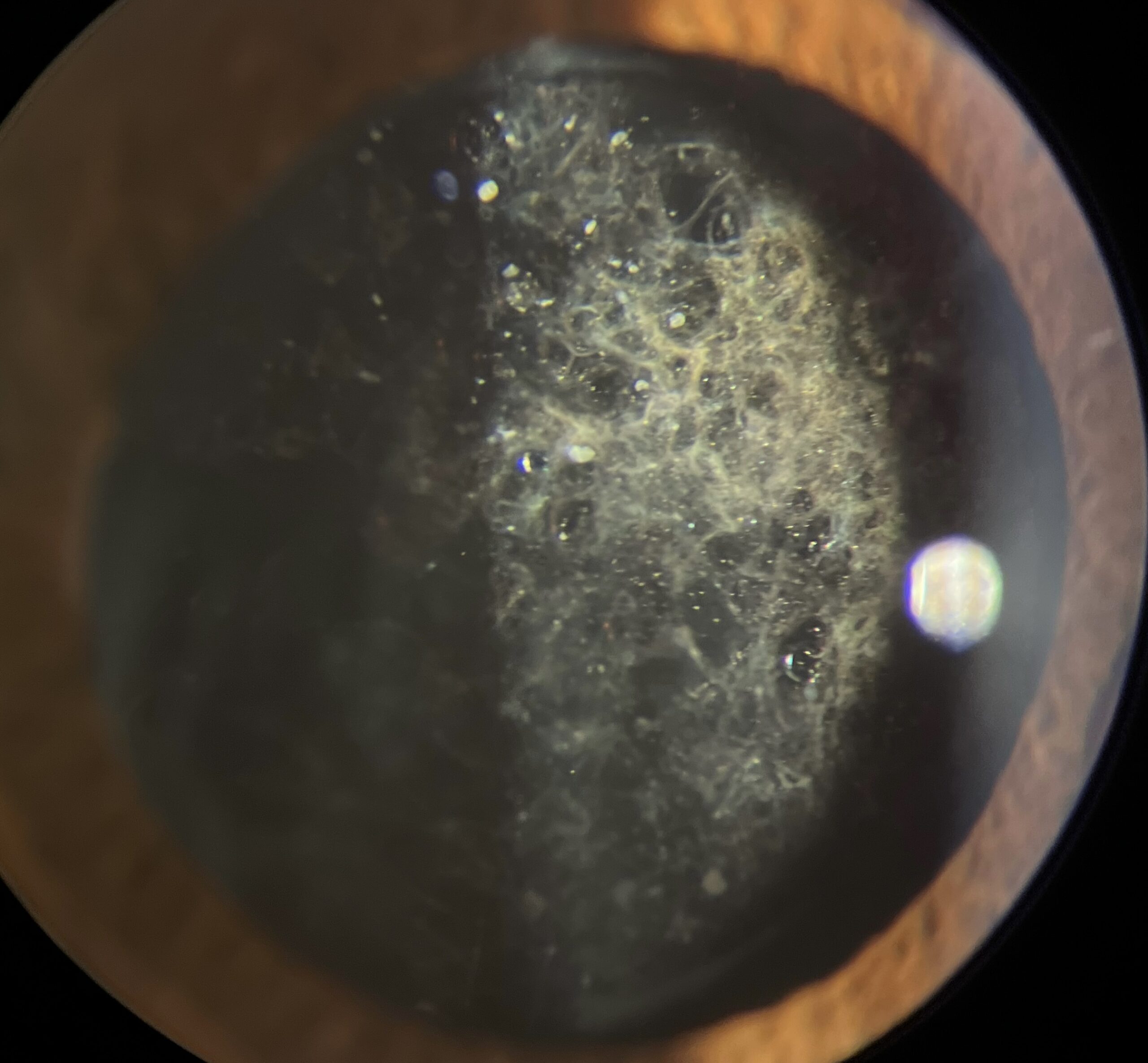 Posterior Capsule opacification