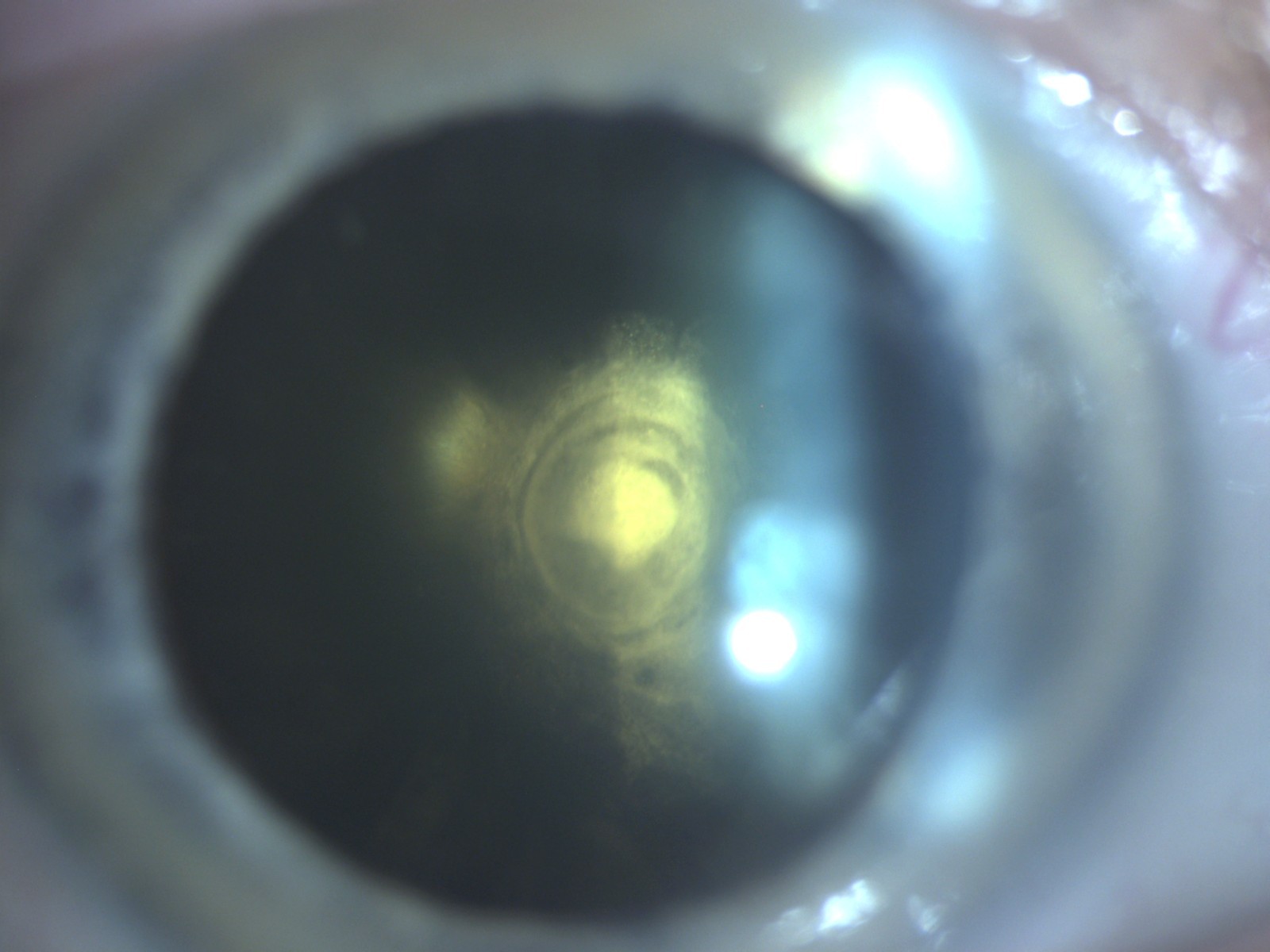 Posterior subcapsular cataract