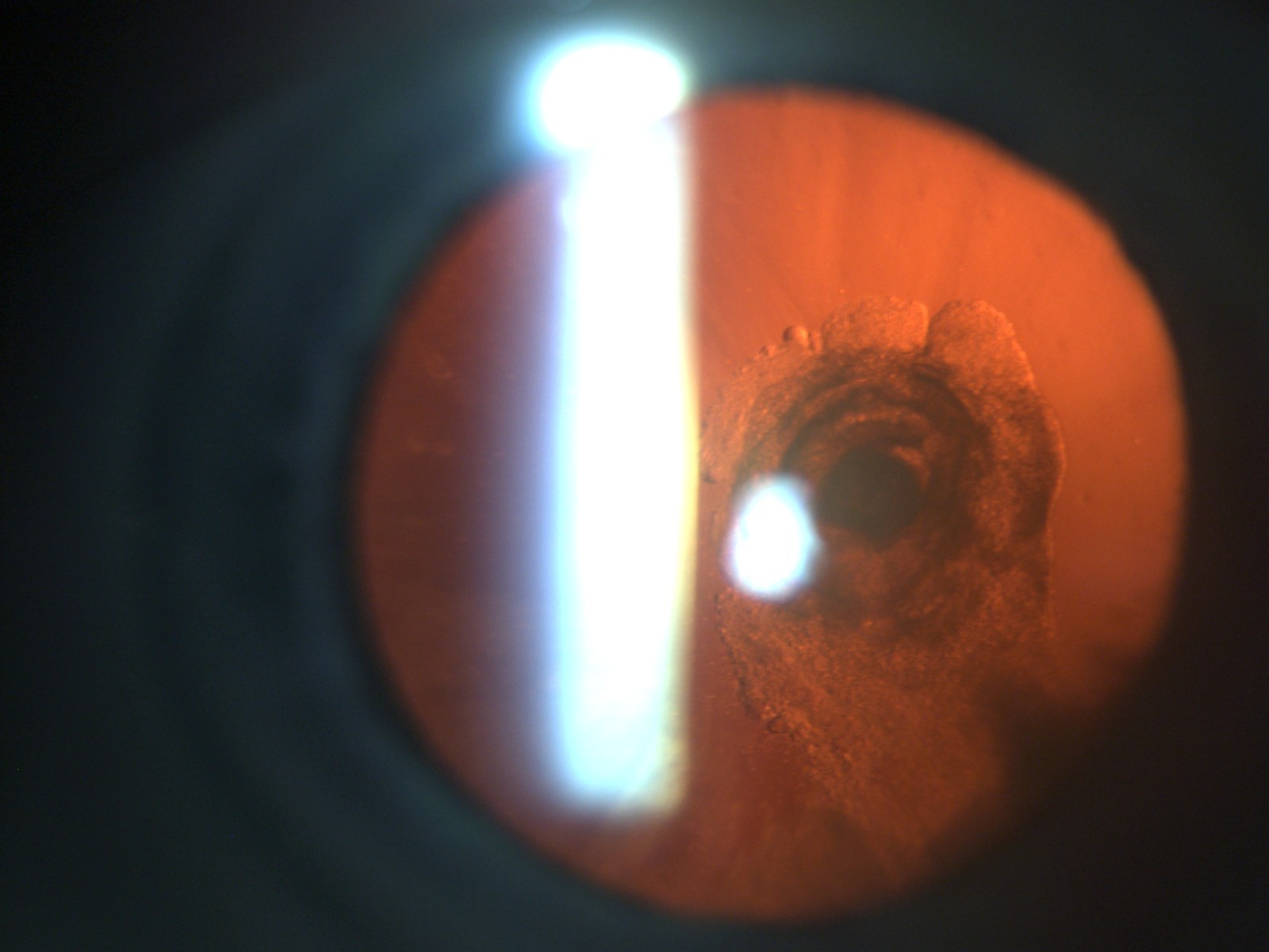 Posterior subcapsular cataract