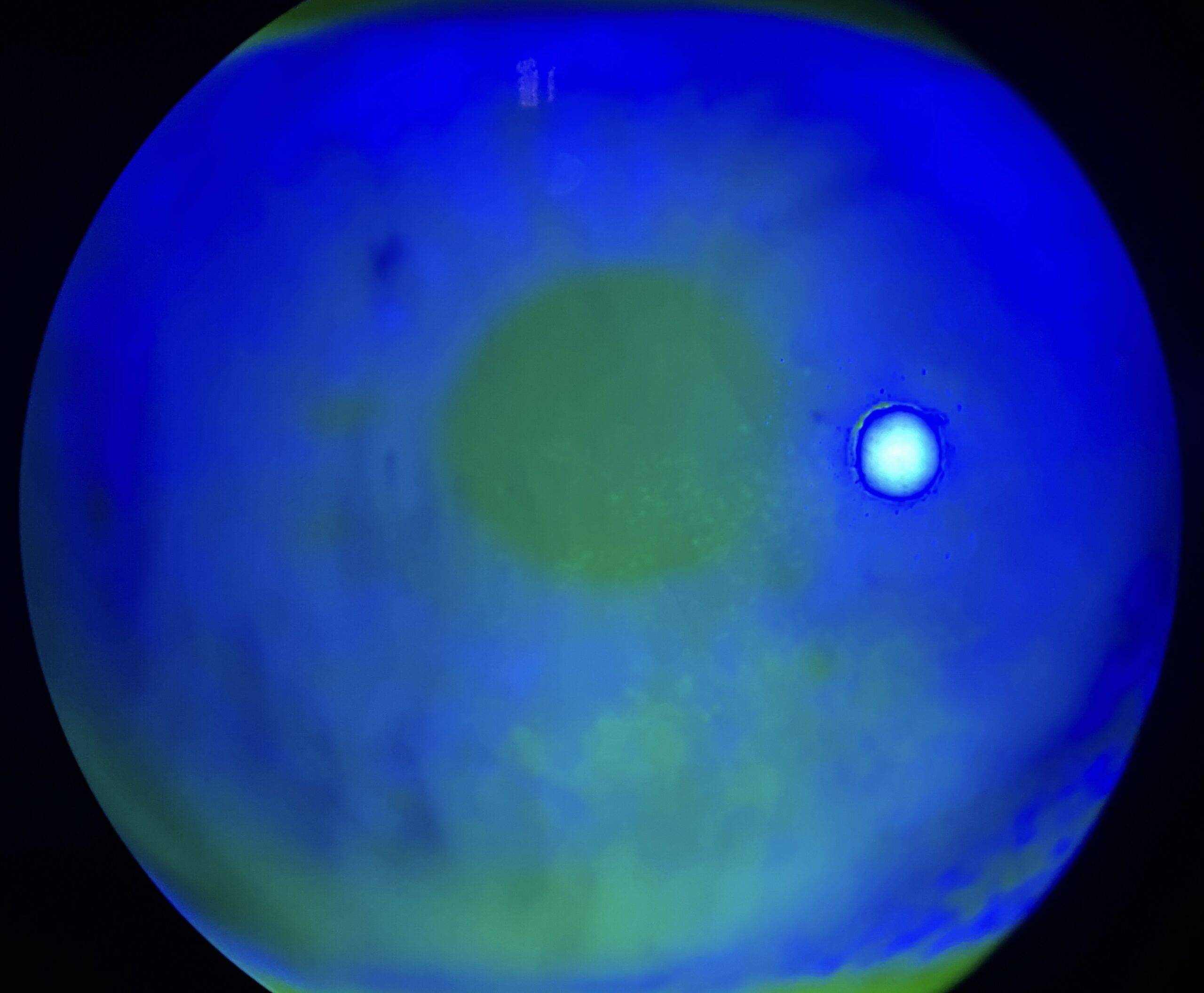 nstable tear film with punctate corneal epithelopathy