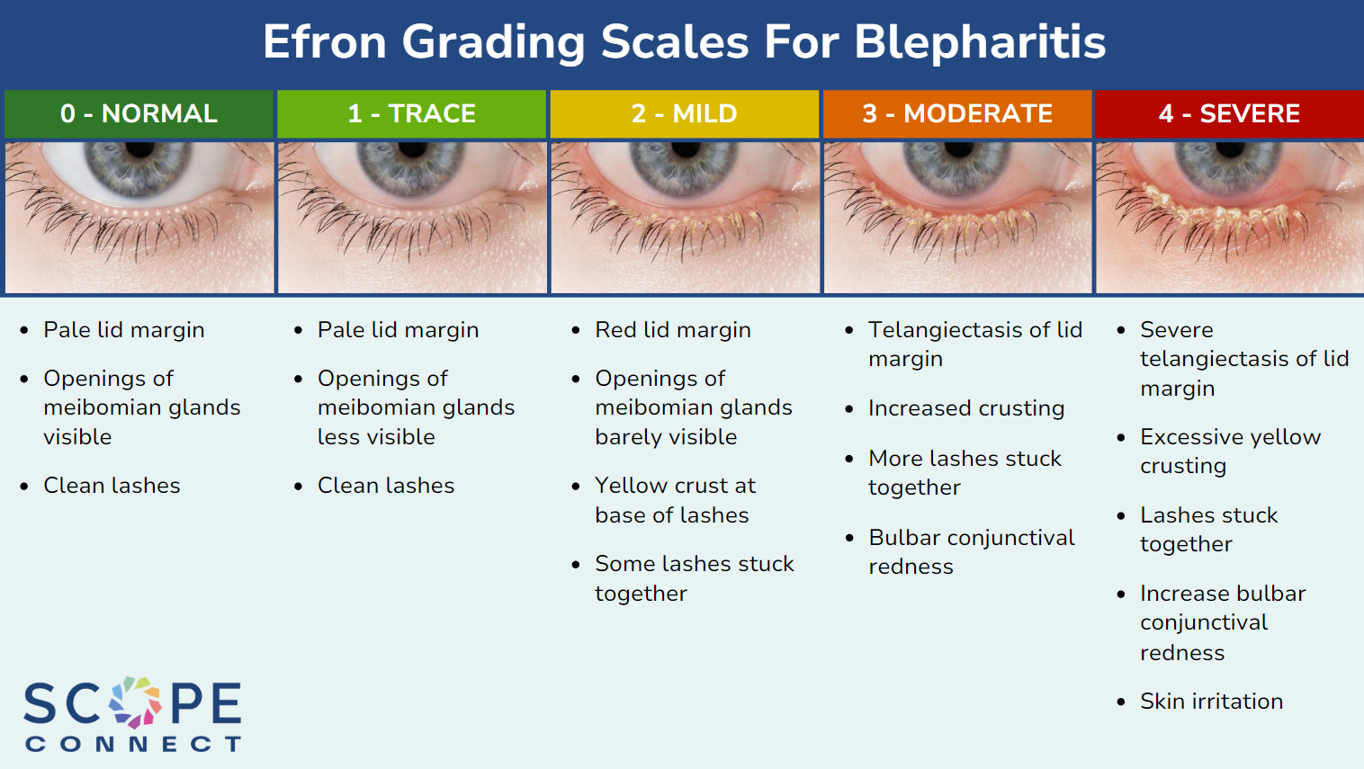 Efron Grading Scales For Blepharitis Scope Connect Efron Grading Scales For Blepharitis Scope Connect