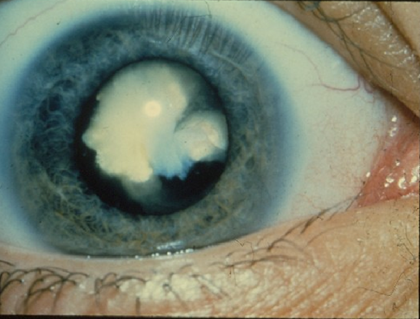 Cataract