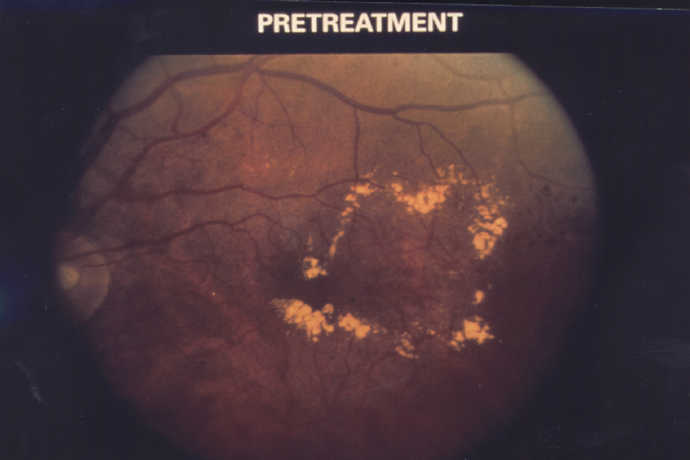 Diabetic Macular Edema