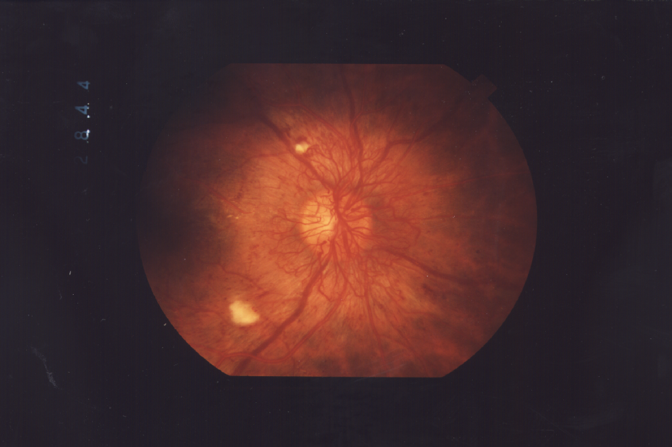 Proliferative Retinopathy