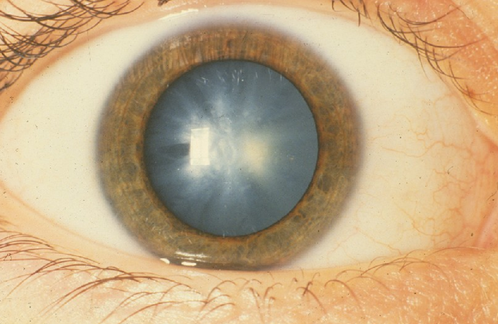 Cataract