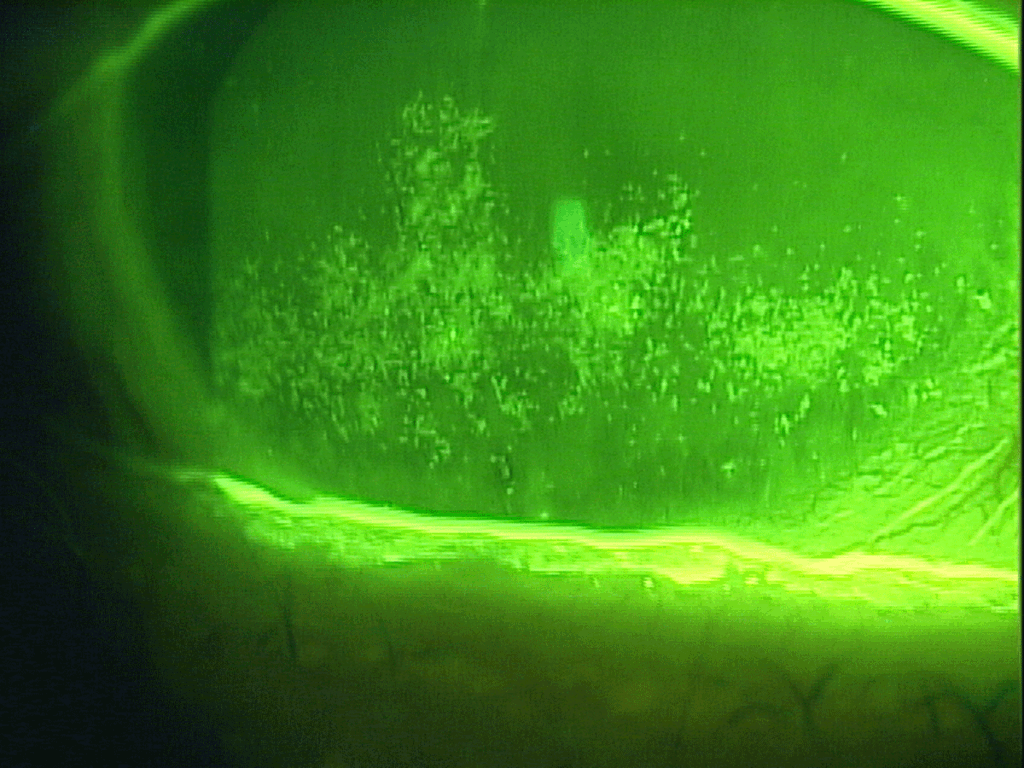 The Molecular Advantage 1 Dry Eye Patient Tear Film Karpecki
