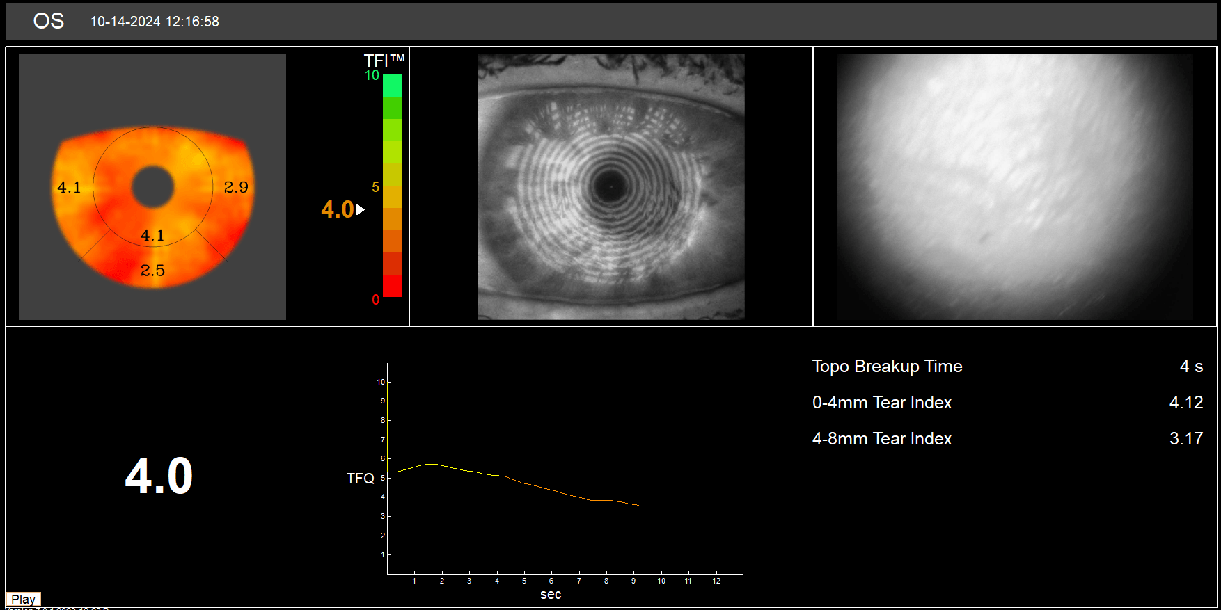 Optimising the Ocular Surface Before Refractive Surgery - Scope Connect