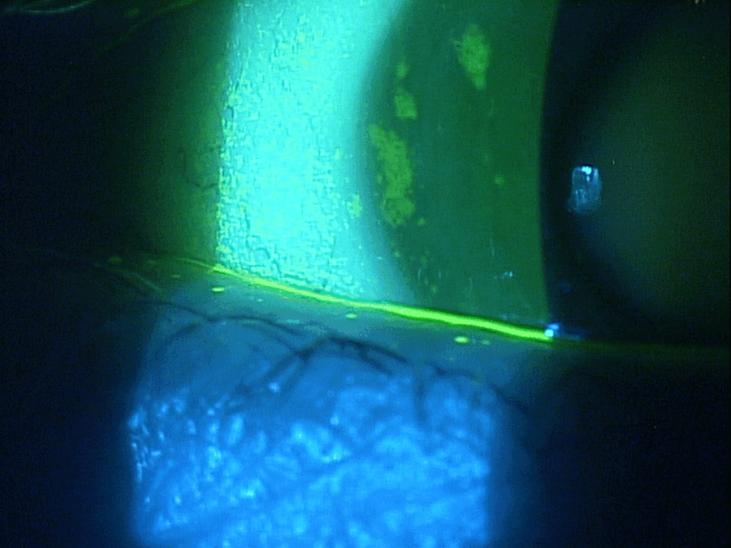The Molecular Advantage 3 Sjogrens Patient Karpecki